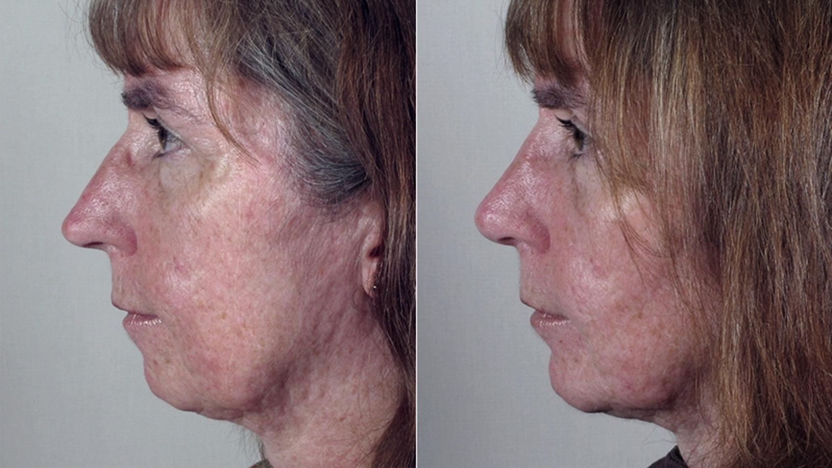 Rhinoplasty Case 145 Before & After View #2 | Paramus, New Jersey | Parker Center for Plastic Surgery