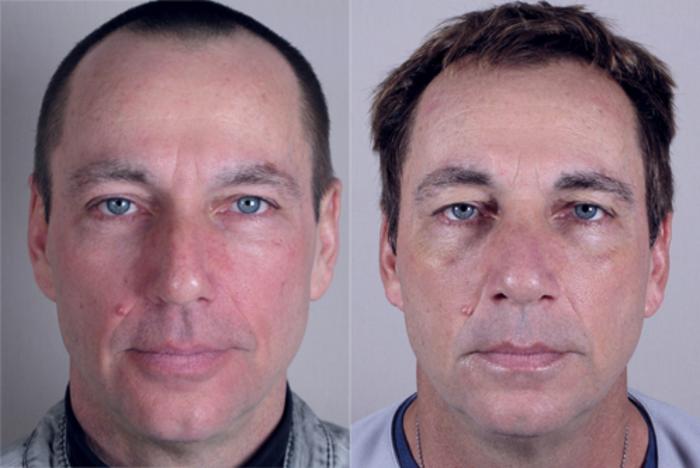 Rhinoplasty Case 146 Before & After View #1 | Paramus, New Jersey | Parker Center for Plastic Surgery