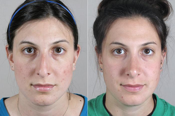 Rhinoplasty Case 147 Before & After View #1 | Paramus, New Jersey | Parker Center for Plastic Surgery