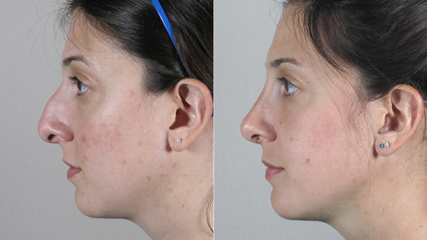 Rhinoplasty Case 147 Before & After View #2 | Paramus, New Jersey | Parker Center for Plastic Surgery