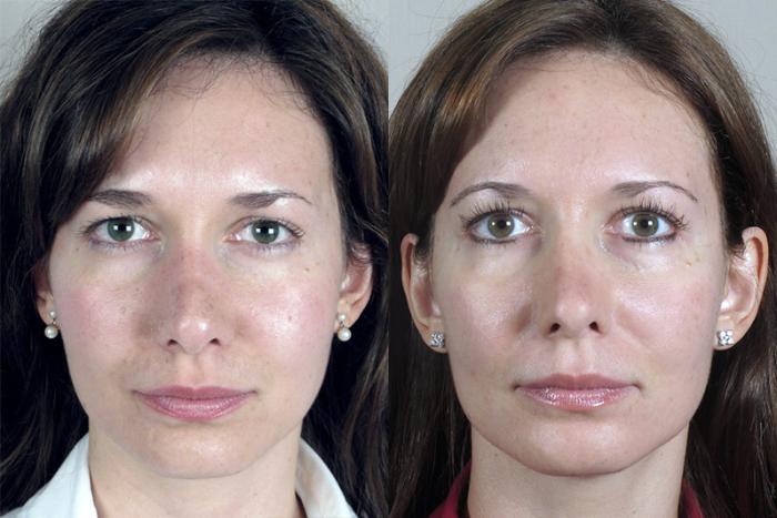 Rhinoplasty Case 148 Before & After View #1 | Paramus, New Jersey | Parker Center for Plastic Surgery