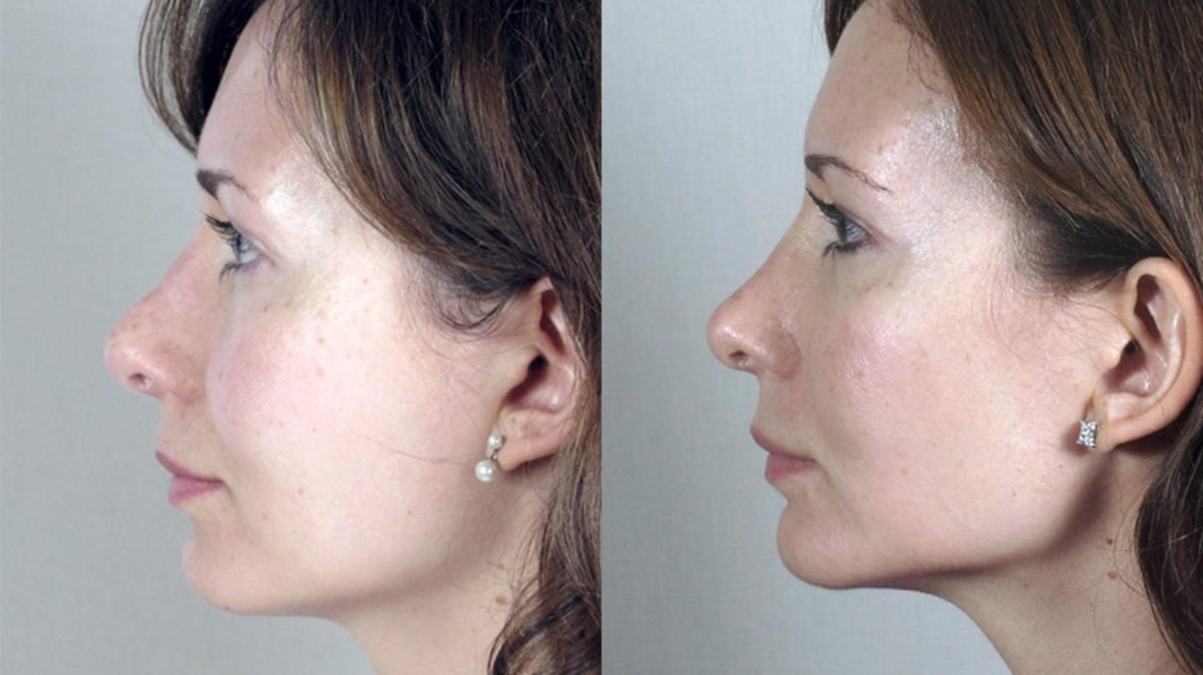 Rhinoplasty Case 148 Before & After View #2 | Paramus, New Jersey | Parker Center for Plastic Surgery