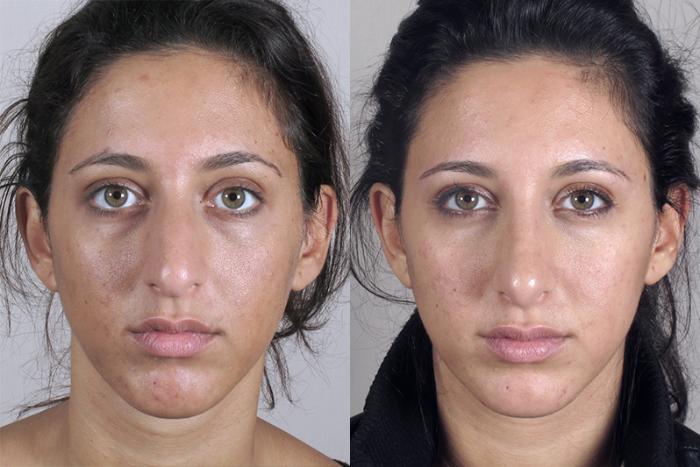 Rhinoplasty Case 149 Before & After View #1 | Paramus, New Jersey | Parker Center for Plastic Surgery