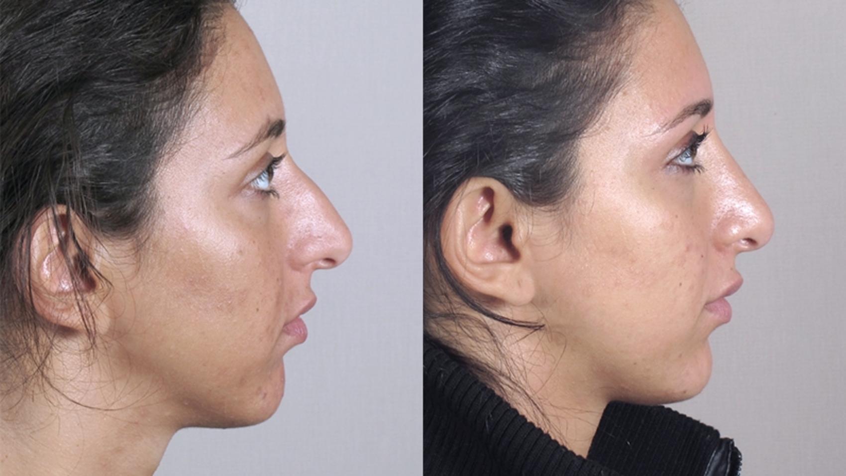 Rhinoplasty Case 149 Before & After View #2 | Paramus, New Jersey | Parker Center for Plastic Surgery