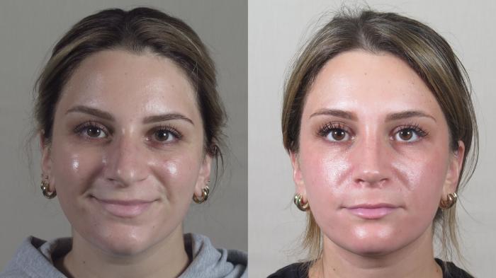 Rhinoplasty Case 1498 Before & After Front | Paramus, New Jersey | Parker Center for Plastic Surgery