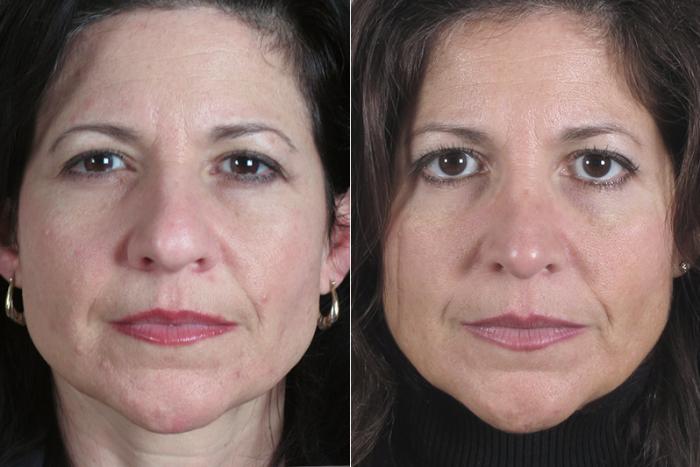 Rhinoplasty Case 150 Before & After View #1 | Paramus, New Jersey | Parker Center for Plastic Surgery