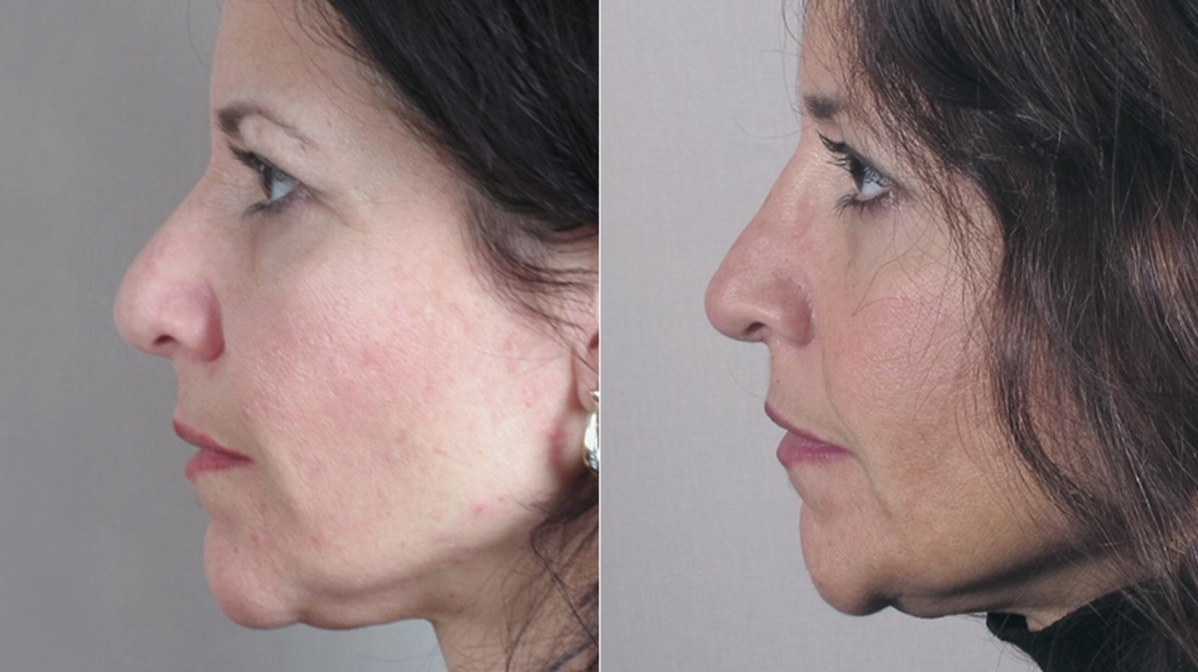 Rhinoplasty Case 150 Before & After View #2 | Paramus, New Jersey | Parker Center for Plastic Surgery