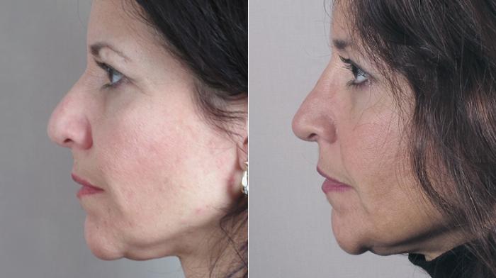 Rhinoplasty Case 150 Before & After View #2 | Paramus, New Jersey | Parker Center for Plastic Surgery