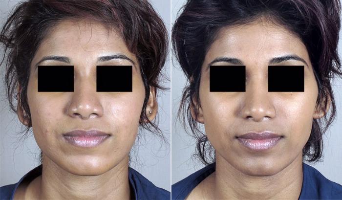 Rhinoplasty Case 151 Before & After View #1 | Paramus, New Jersey | Parker Center for Plastic Surgery