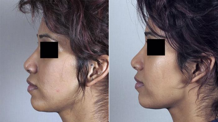 Rhinoplasty Case 151 Before & After View #2 | Paramus, New Jersey | Parker Center for Plastic Surgery