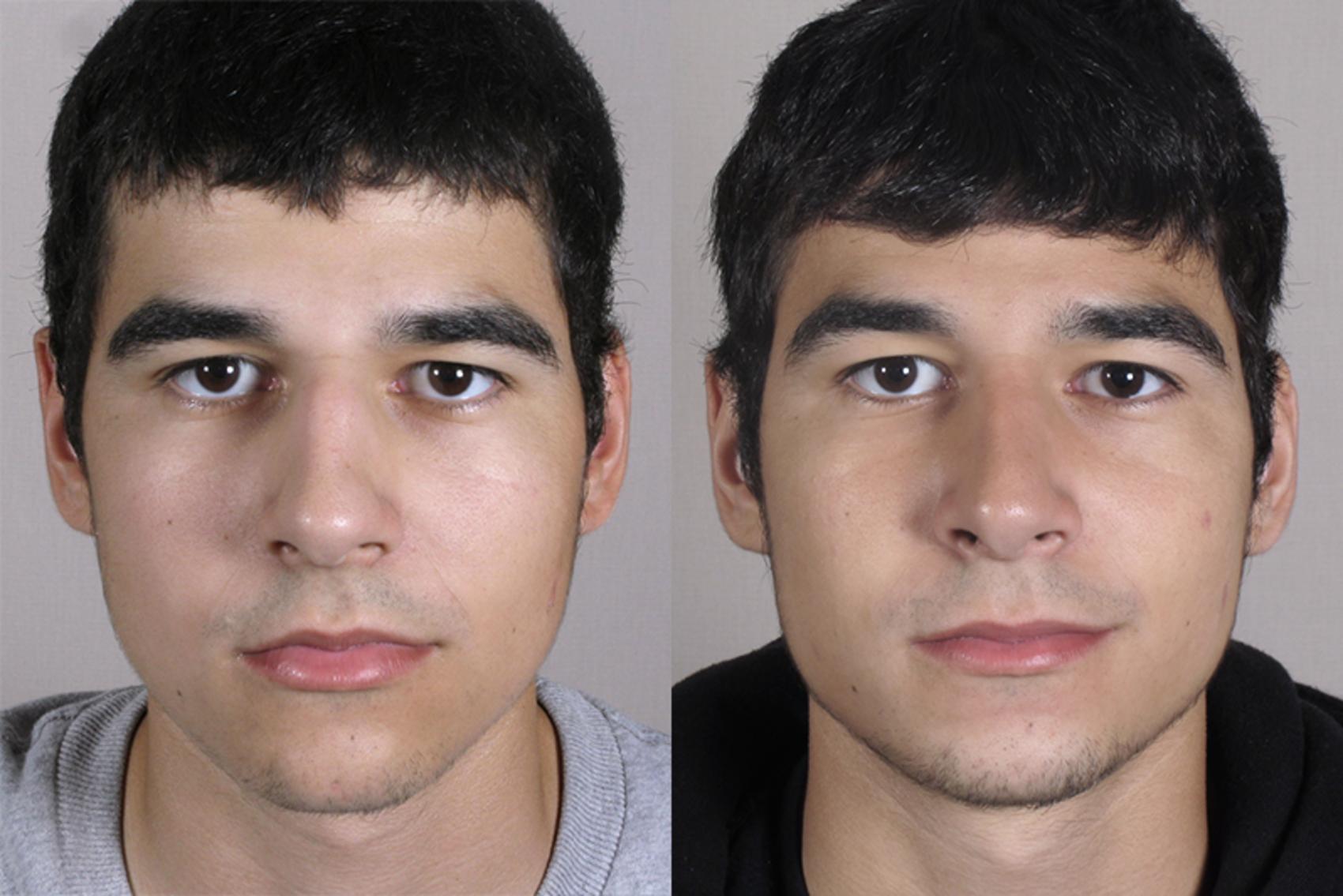 Rhinoplasty Case 152 Before & After View #1 | Paramus, New Jersey | Parker Center for Plastic Surgery