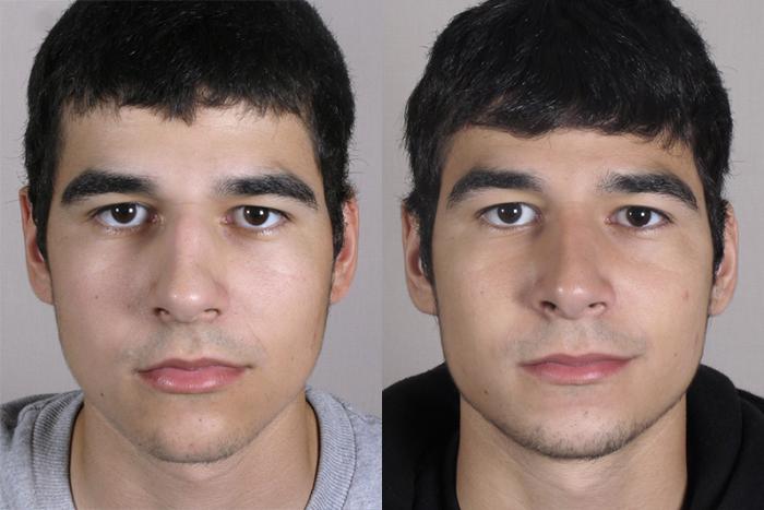 Rhinoplasty Case 152 Before & After View #1 | Paramus, New Jersey | Parker Center for Plastic Surgery