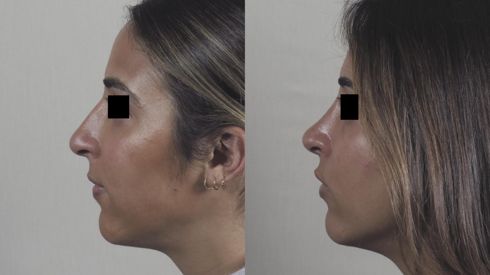 Rhinoplasty Case 1520 Before & After Left Side | Paramus, New Jersey | Parker Center for Plastic Surgery