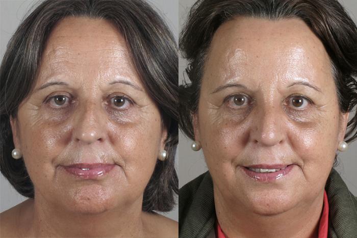 Rhinoplasty Case 153 Before & After View #1 | Paramus, New Jersey | Parker Center for Plastic Surgery