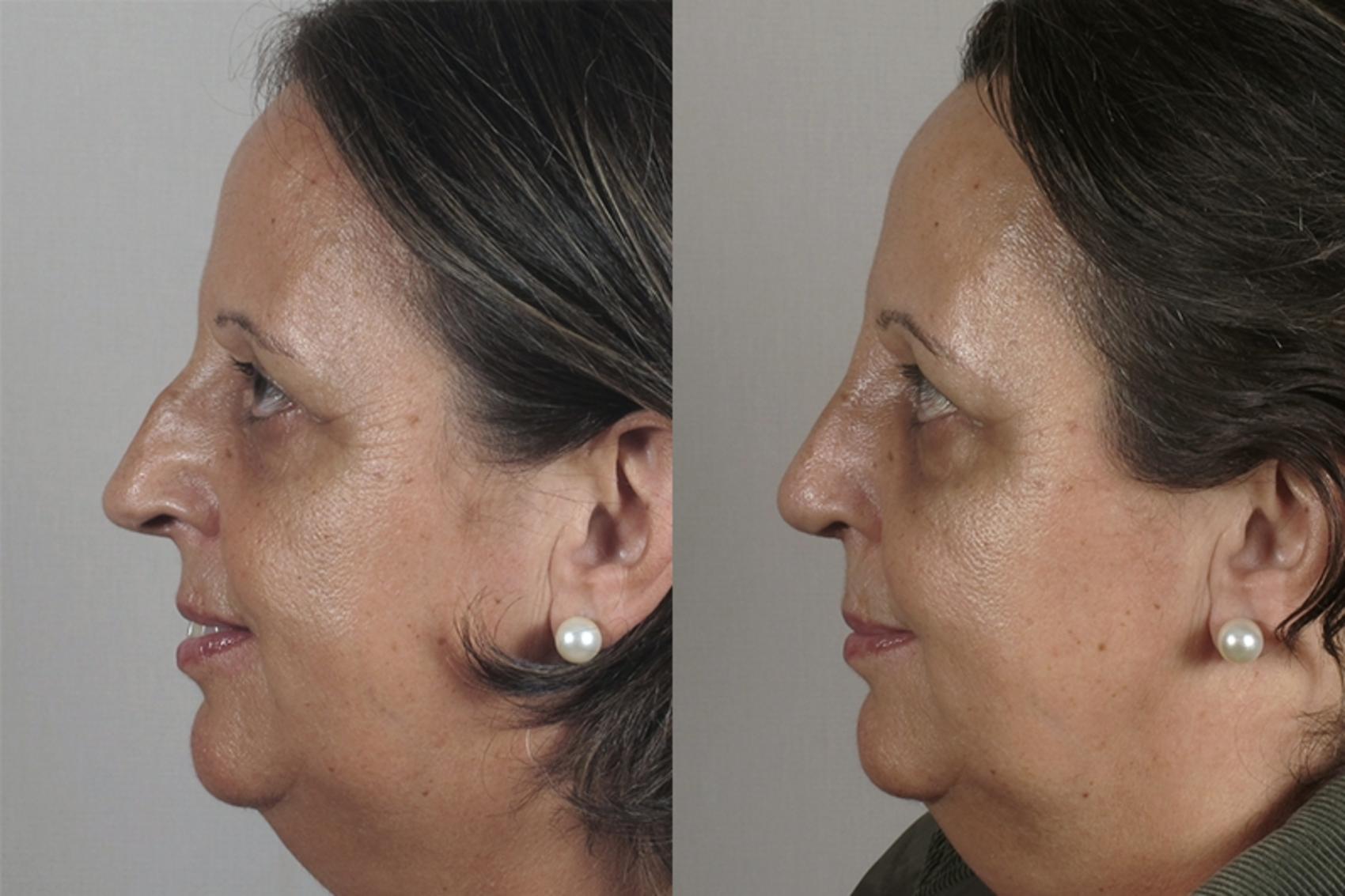 Rhinoplasty Case 153 Before & After View #2 | Paramus, New Jersey | Parker Center for Plastic Surgery