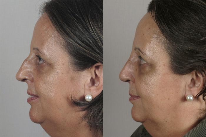 Rhinoplasty Case 153 Before & After View #2 | Paramus, New Jersey | Parker Center for Plastic Surgery