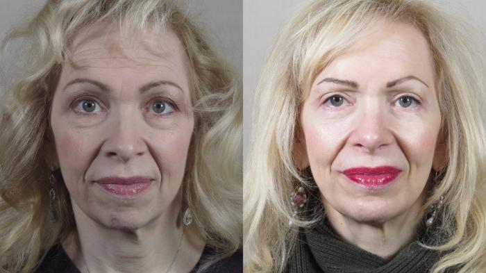 Rhinoplasty Case 1533 Before & After Front | Paramus, New Jersey | Parker Center for Plastic Surgery