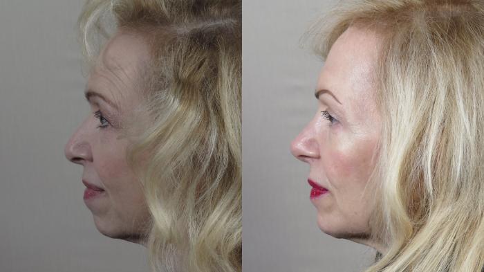 Rhinoplasty Case 1533 Before & After Left Side | Paramus, New Jersey | Parker Center for Plastic Surgery