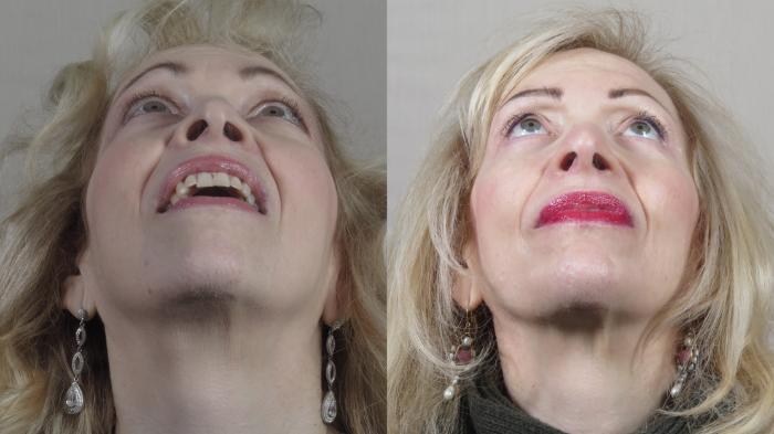 Rhinoplasty Case 1533 Before & After Worn's | Paramus, New Jersey | Parker Center for Plastic Surgery