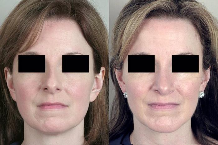 Rhinoplasty Case 154 Before & After View #1 | Paramus, New Jersey | Parker Center for Plastic Surgery