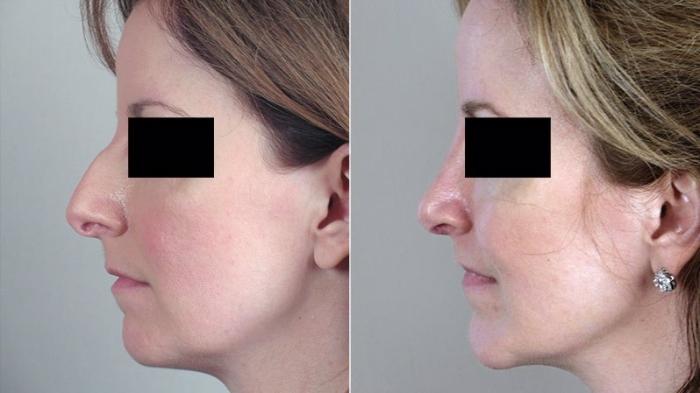 Rhinoplasty Case 154 Before & After View #2 | Paramus, New Jersey | Parker Center for Plastic Surgery