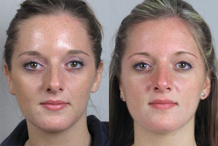 Rhinoplasty Case 156 Before & After View #1 | Paramus, New Jersey | Parker Center for Plastic Surgery