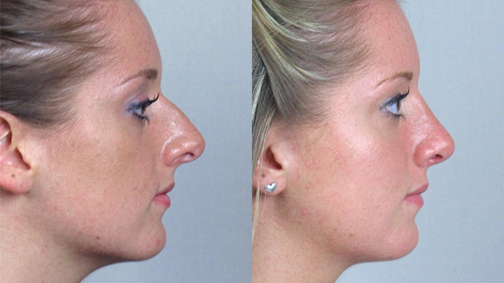 Rhinoplasty Case 156 Before & After View #2 | Paramus, New Jersey | Parker Center for Plastic Surgery