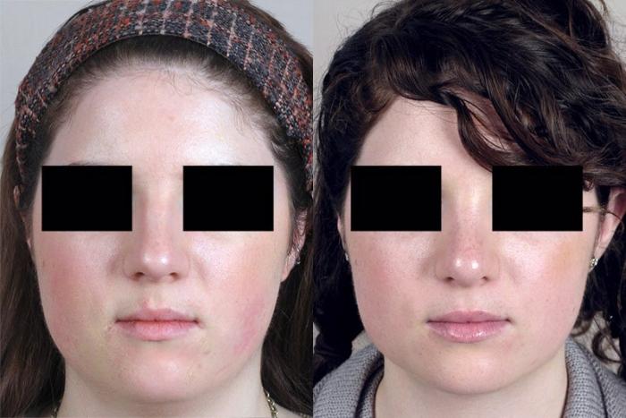 Rhinoplasty Case 157 Before & After View #1 | Paramus, New Jersey | Parker Center for Plastic Surgery