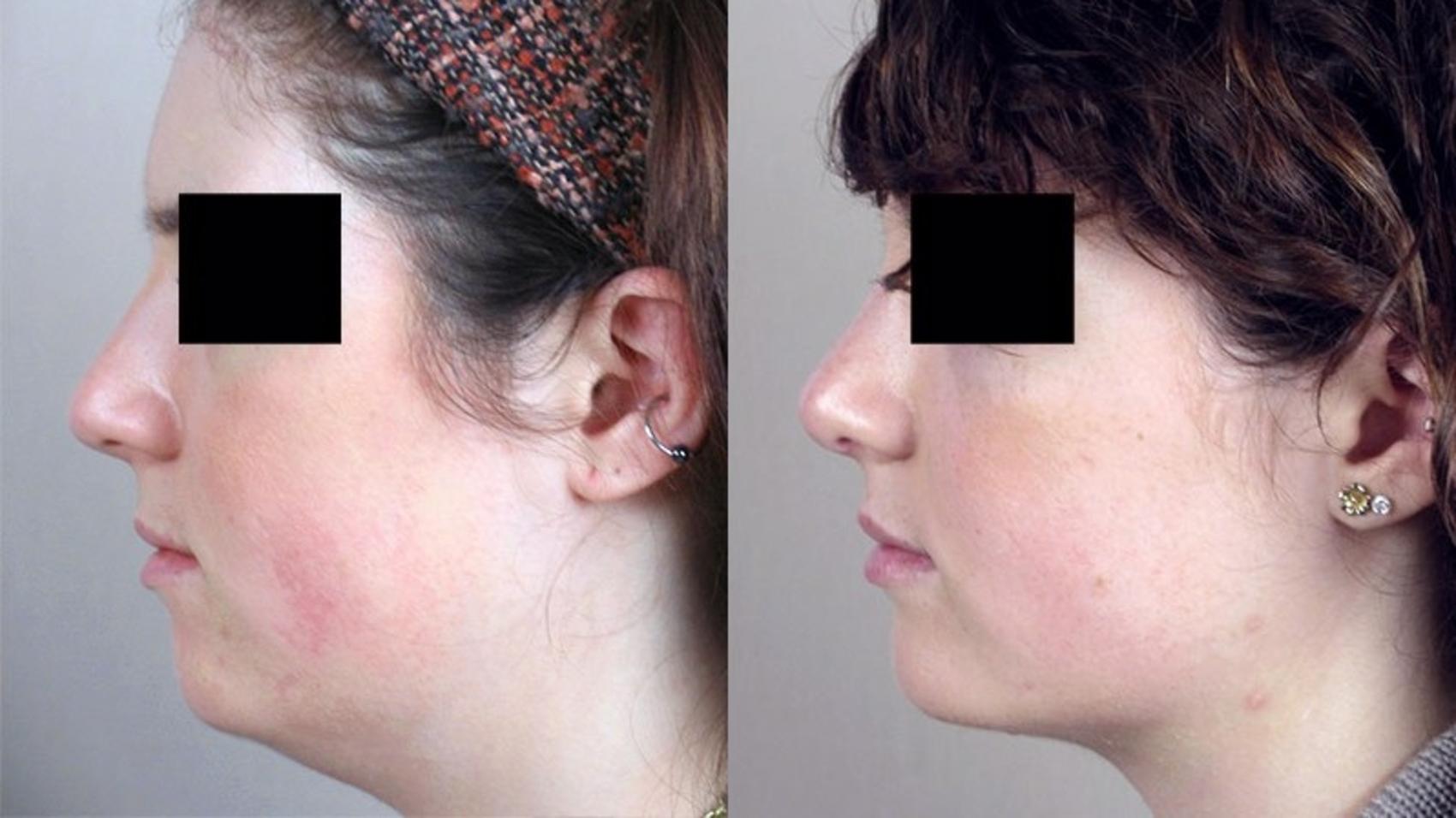 Rhinoplasty Case 157 Before & After View #2 | Paramus, New Jersey | Parker Center for Plastic Surgery
