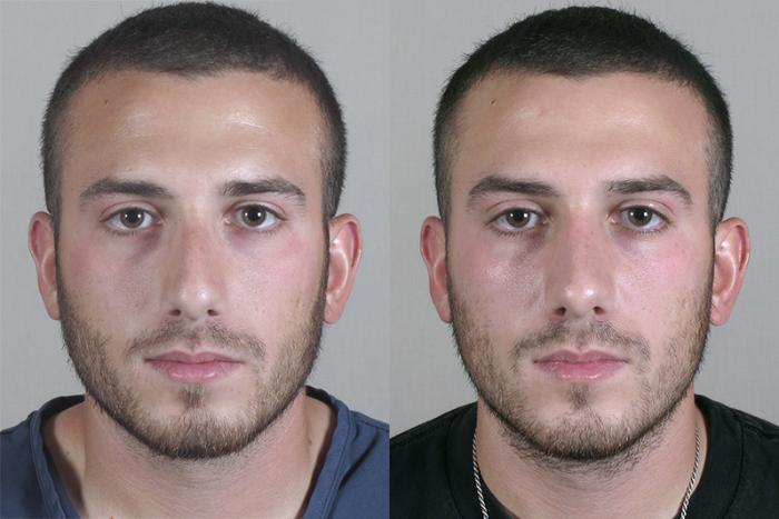 Rhinoplasty Case 158 Before & After View #1 | Paramus, New Jersey | Parker Center for Plastic Surgery