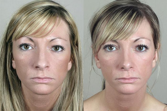 Rhinoplasty Case 159 Before & After View #1 | Paramus, New Jersey | Parker Center for Plastic Surgery