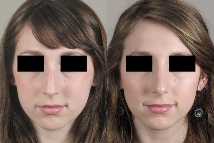 Rhinoplasty Case 160 Before & After View #1 | Paramus, New Jersey | Parker Center for Plastic Surgery