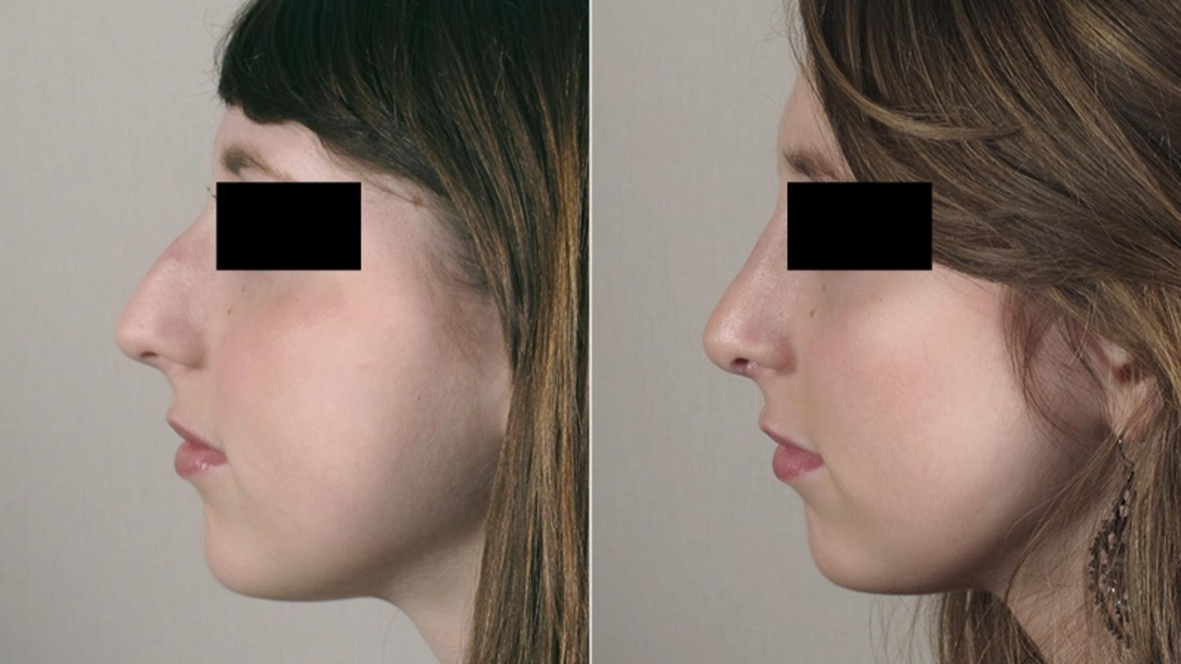 Rhinoplasty Case 160 Before & After View #2 | Paramus, New Jersey | Parker Center for Plastic Surgery
