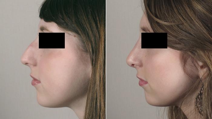 Rhinoplasty Case 160 Before & After View #2 | Paramus, New Jersey | Parker Center for Plastic Surgery