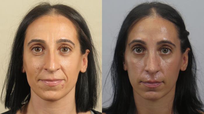 Rhinoplasty Case 1600 Before & After Front | Paramus, New Jersey | Parker Center for Plastic Surgery