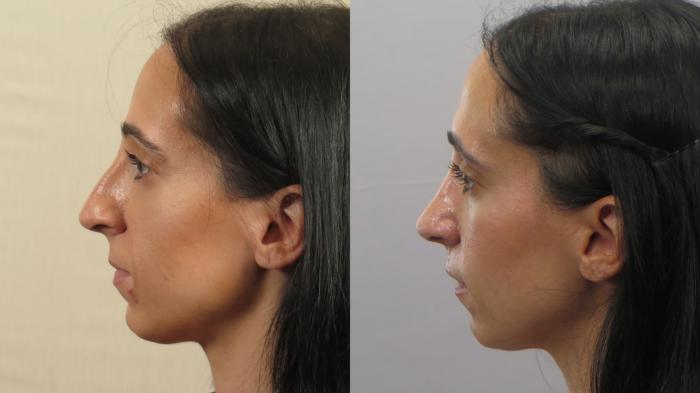Rhinoplasty Case 1600 Before & After Left Side | Paramus, New Jersey | Parker Center for Plastic Surgery