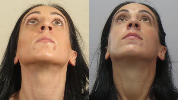 Rhinoplasty Case 1600 Before & After worm's | Paramus, New Jersey | Parker Center for Plastic Surgery