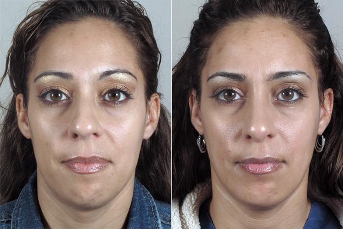 Rhinoplasty Case 161 Before & After View #1 | Paramus, New Jersey | Parker Center for Plastic Surgery