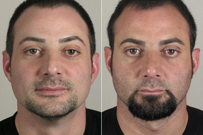 Rhinoplasty Case 162 Before & After View #1 | Paramus, New Jersey | Parker Center for Plastic Surgery