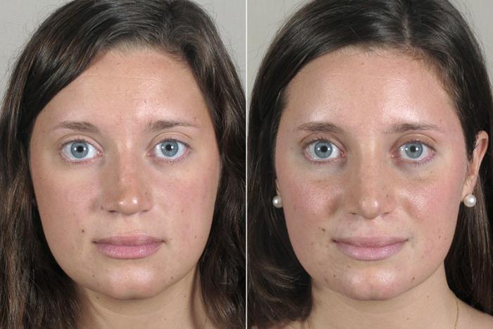 Rhinoplasty Case 163 Before & After View #1 | Paramus, New Jersey | Parker Center for Plastic Surgery