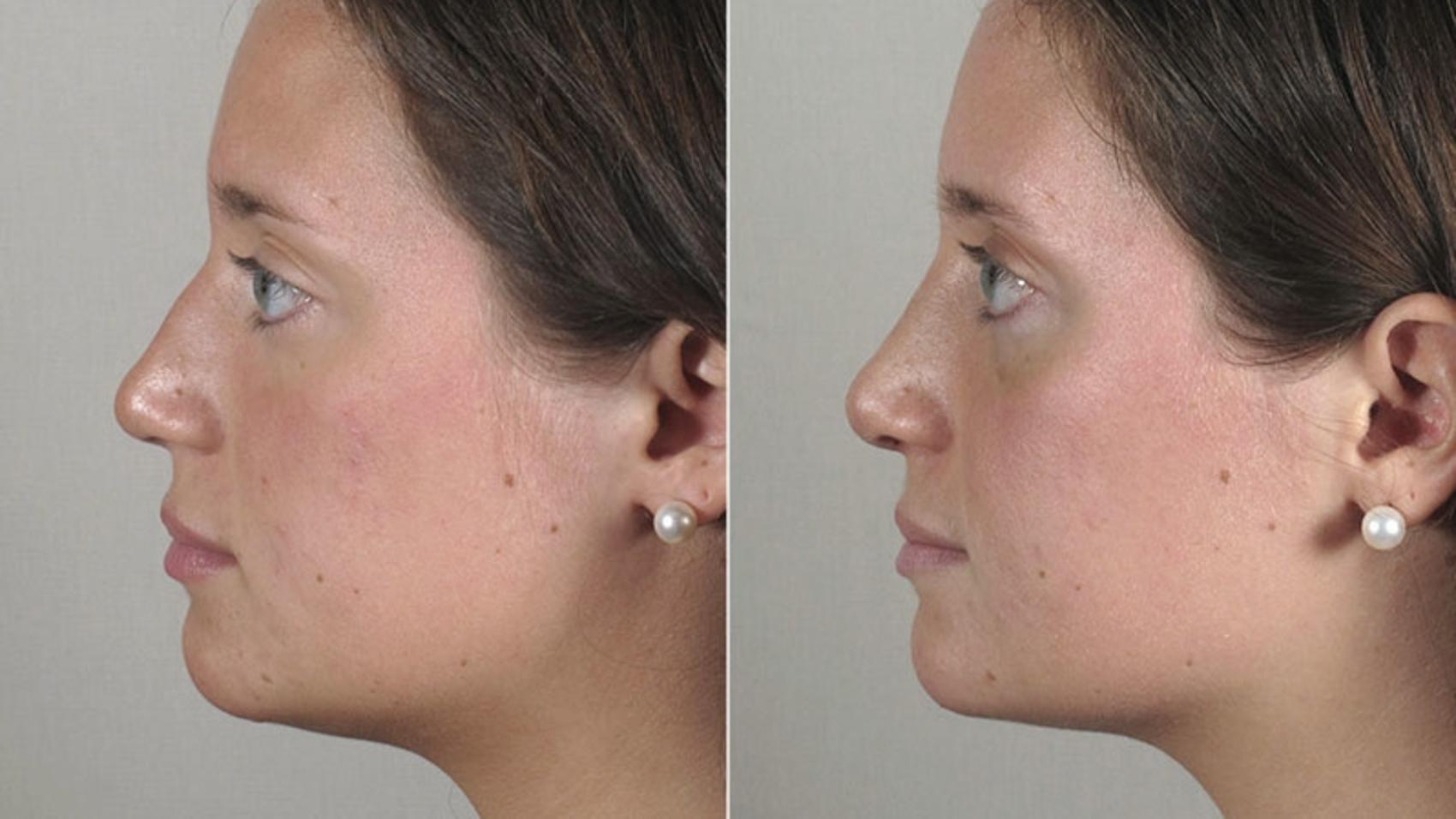 Rhinoplasty Case 163 Before & After View #2 | Paramus, New Jersey | Parker Center for Plastic Surgery