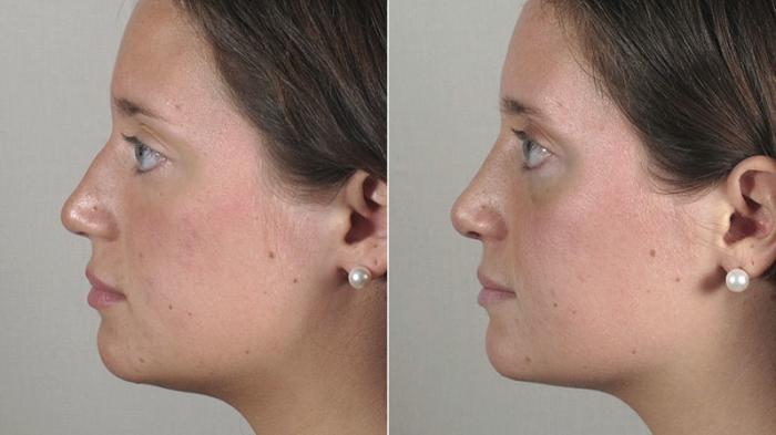 Rhinoplasty Case 163 Before & After View #2 | Paramus, New Jersey | Parker Center for Plastic Surgery