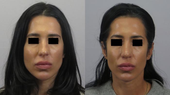Rhinoplasty Case 1634 Before & After front 1 | Paramus, New Jersey | Parker Center for Plastic Surgery