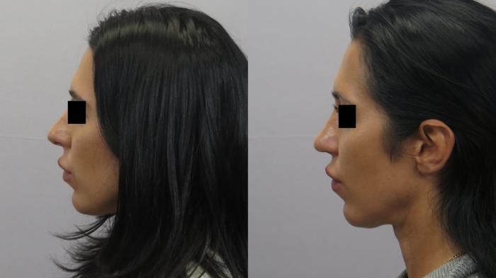 Rhinoplasty Case 1634 Before & After Left Side | Paramus, New Jersey | Parker Center for Plastic Surgery