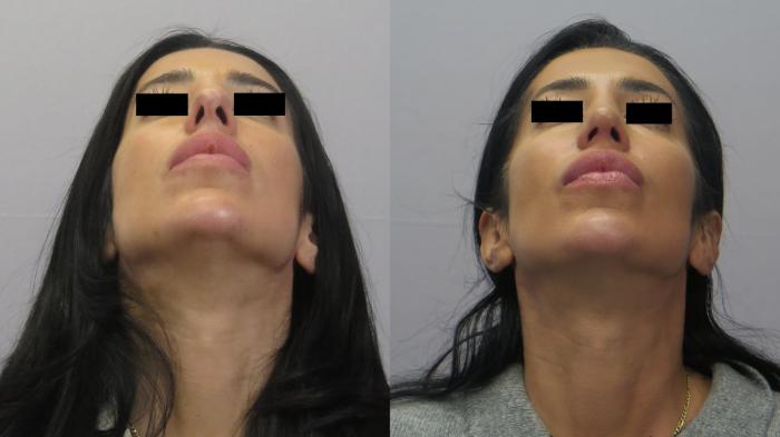 Rhinoplasty Case 1634 Before & After worms | Paramus, New Jersey | Parker Center for Plastic Surgery