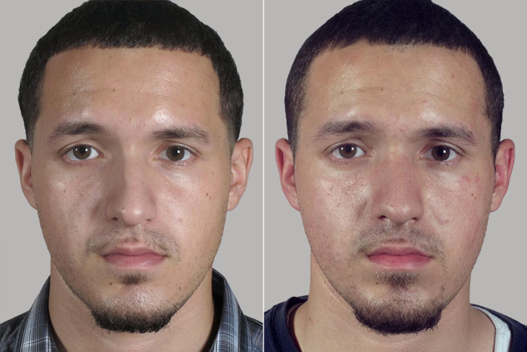 Rhinoplasty Case 164 Before & After View #1 | Paramus, New Jersey | Parker Center for Plastic Surgery