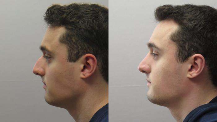 Rhinoplasty Case 1643 Before & After Left Side | Paramus, New Jersey | Parker Center for Plastic Surgery