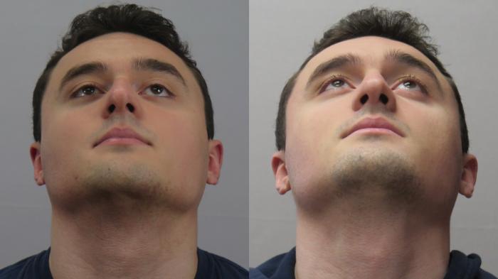 Rhinoplasty Case 1643 Before & After worms | Paramus, New Jersey | Parker Center for Plastic Surgery