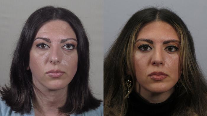 Rhinoplasty Case 1647 Before & After Front | Paramus, New Jersey | Parker Center for Plastic Surgery