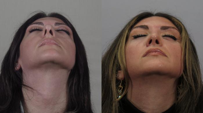 Rhinoplasty Case 1647 Before & After worms | Paramus, New Jersey | Parker Center for Plastic Surgery